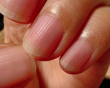 指甲長白點不是缺鈣！ 真要擔心的指甲是這樣的