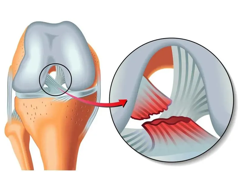 ligament